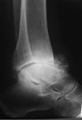 Artroskopinė čiurnos artrodezė