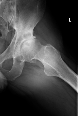 Osteofitas pašalintas