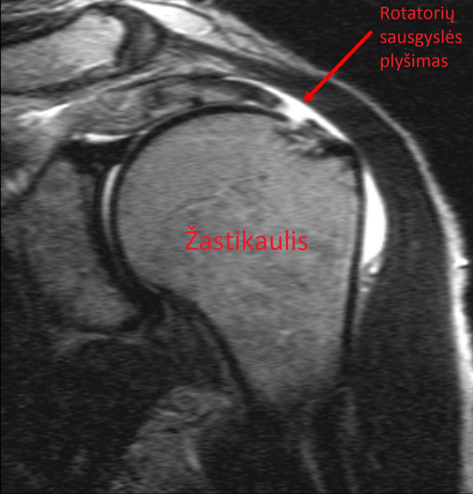 Rotatorių plyšimas, matomas magnetinio rezonanso tomografijoje
